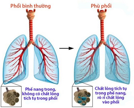 Suy thận cấp có thể gây biến chứng phù phổi cấp