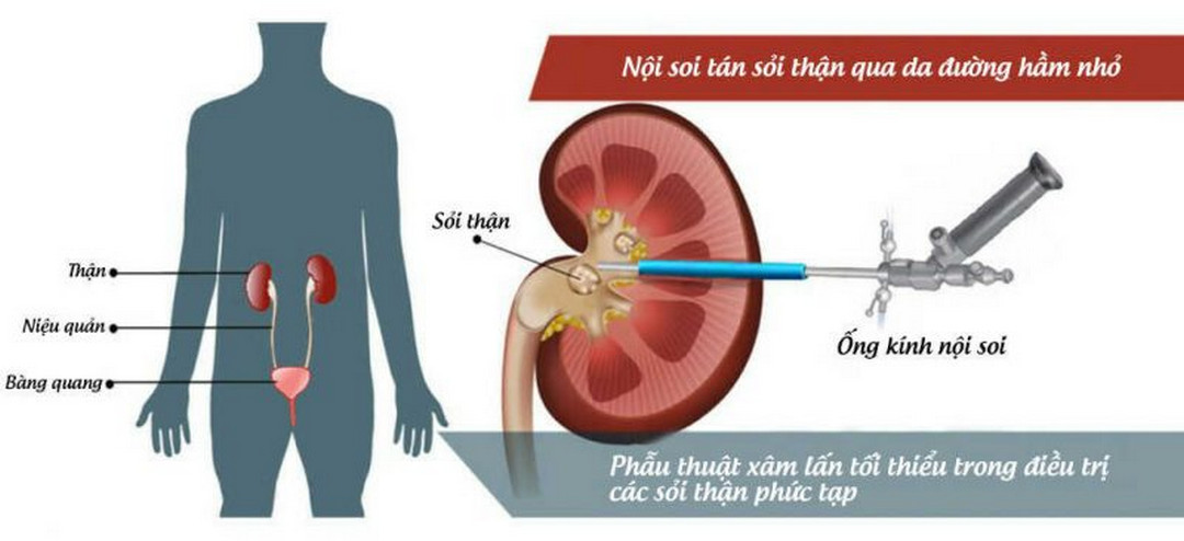 Sỏi thận to làm nghẽn và gây đau thường phải can thiệp phẫu thuật 