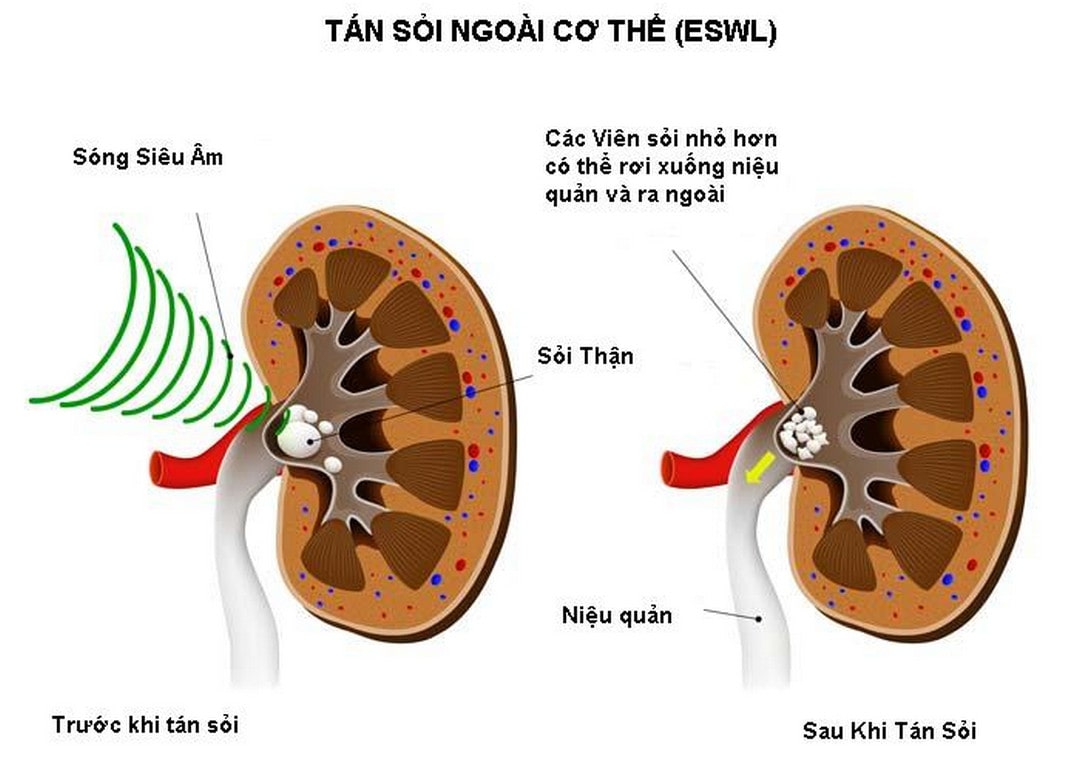 6+ Cách đẩy sỏi thận ra ngoài an toàn, tiên tiến hiện nay