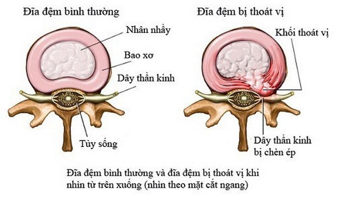 Nguyên lý cơ bản của bệnh thoát vị đĩa đệm cột sống