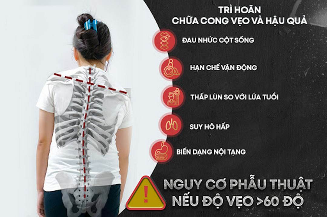 Vẹo cột sống ảnh hưởng tới sức khỏe, sinh hoạt của người bệnh