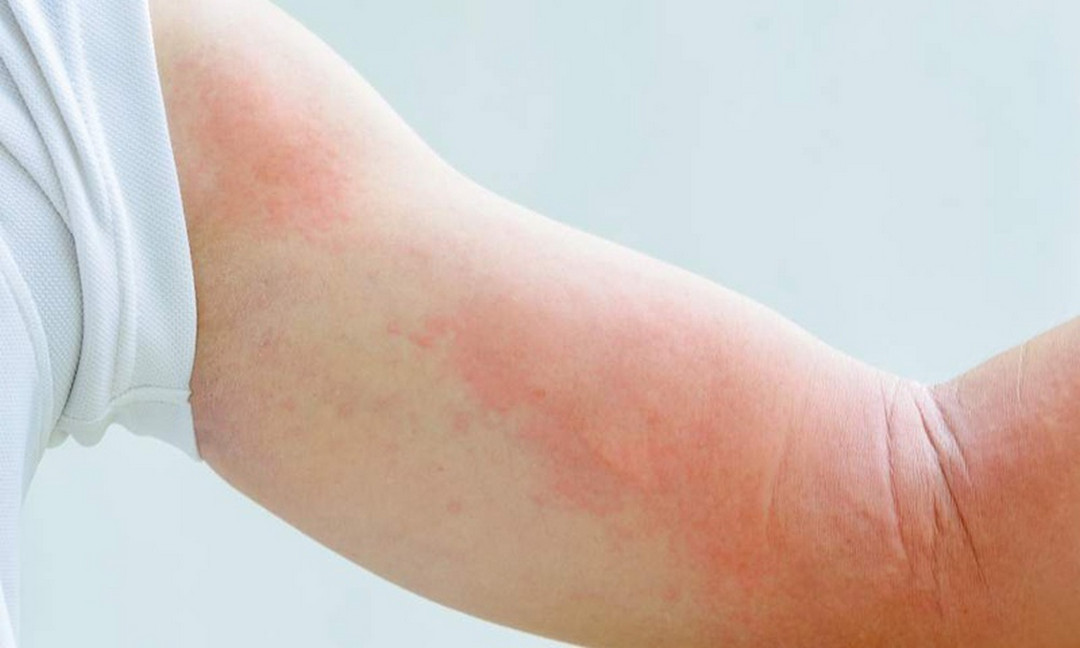 Mẩn ngứa mề đay do nhiễm giun sán