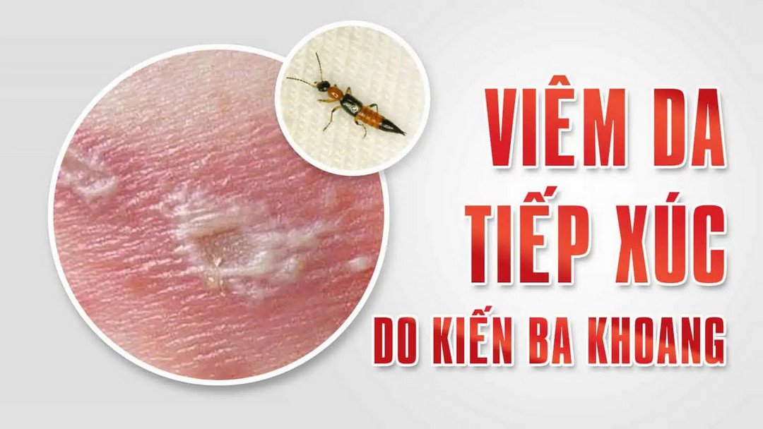 Viêm da tiếp xúc do kiến ba khoang có ngứa kèm mẩn đỏ, đau rát