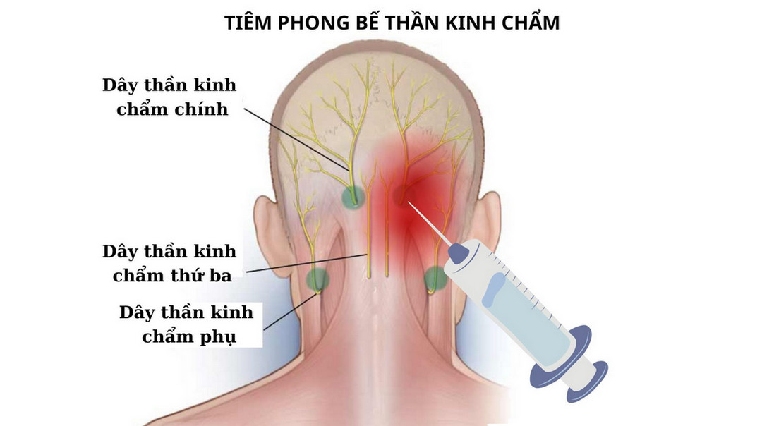 Phương pháp phong bế thần kinh chẩm ít xâm lấn