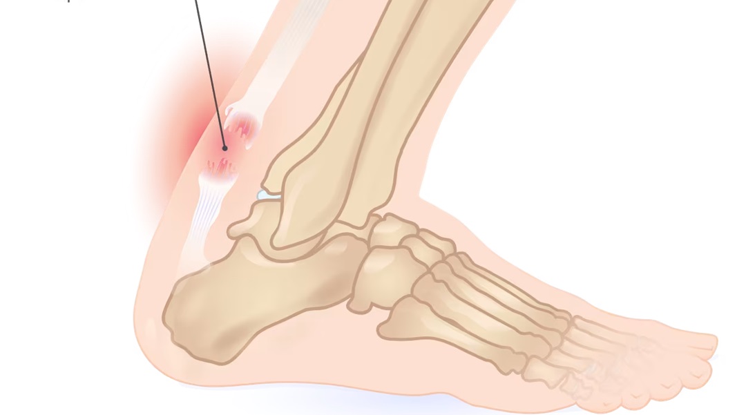 Gót chân là vị trí thường bị đứt gân