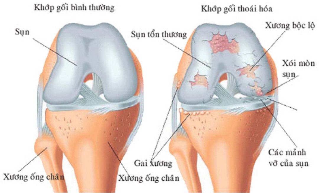 Nguy cơ thoái hóa khớp gối sau chấn thương đứt dây chằng