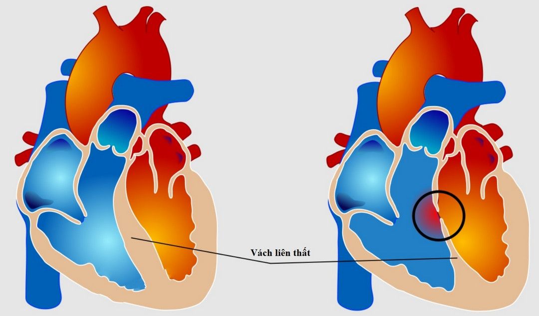 Dị tật vách ngăn liên thất gây bệnh tim bẩm sinh