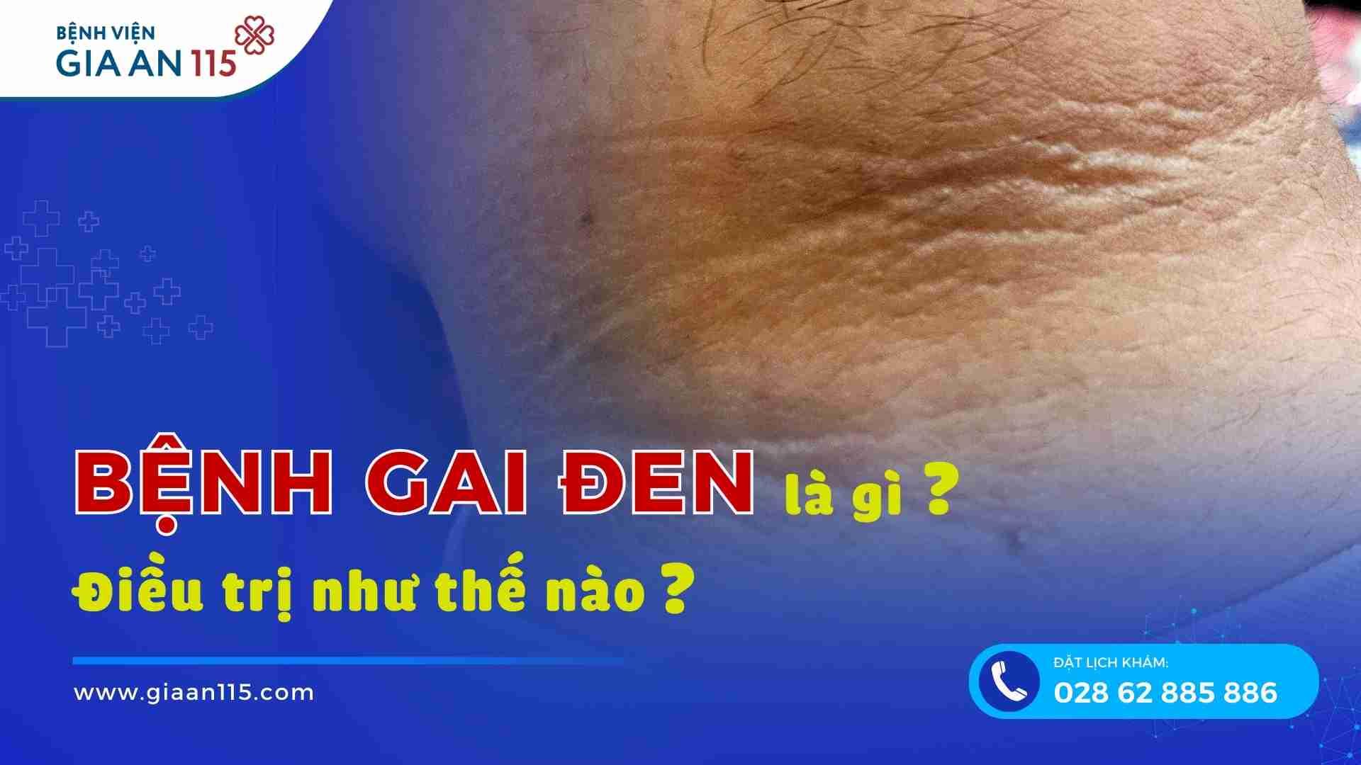 Bệnh gai đen là gì, có nguy hiểm không và điều trị ra sao?