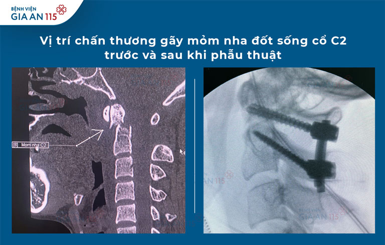 Cứu nam thanh niên thoát nguy cơ liệt sau gãy cột sống cổ phức tạp