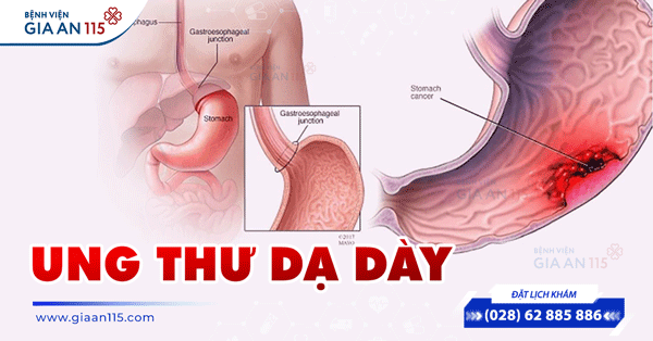 Nhiễm vi khuẩn HP, khi nào cần điều trị diệt trừ?