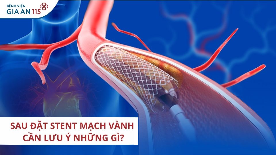 Chăm sóc sau đặt stent mạch vành: Những lưu ý để bảo vệ tim mạch