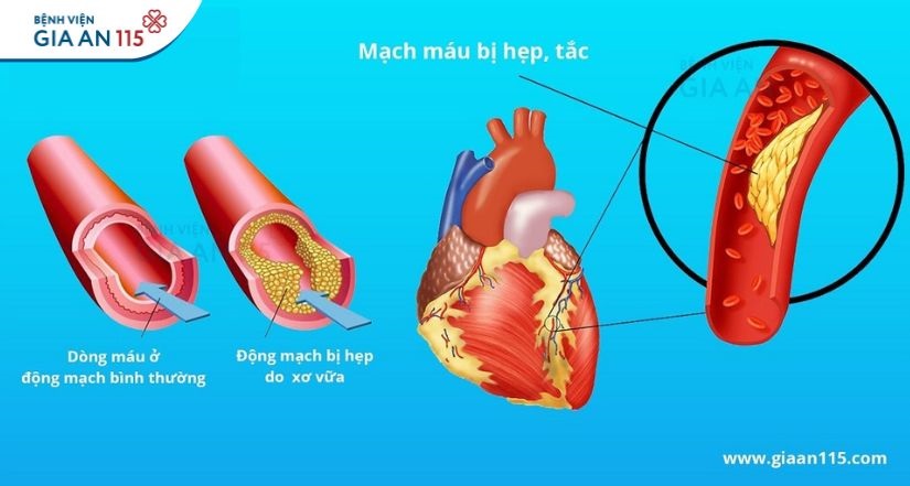 Chăm sóc sau đặt stent mạch vành: Những lưu ý để bảo vệ tim mạch