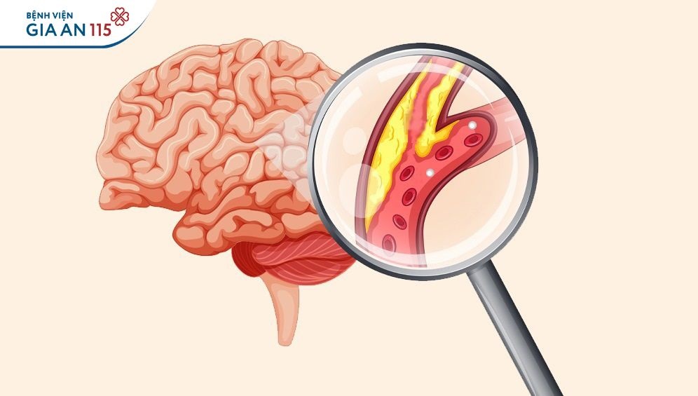 Thiểu năng tuần hoàn máu não do nguyên nhân nào, nguy hiểm ra sao?