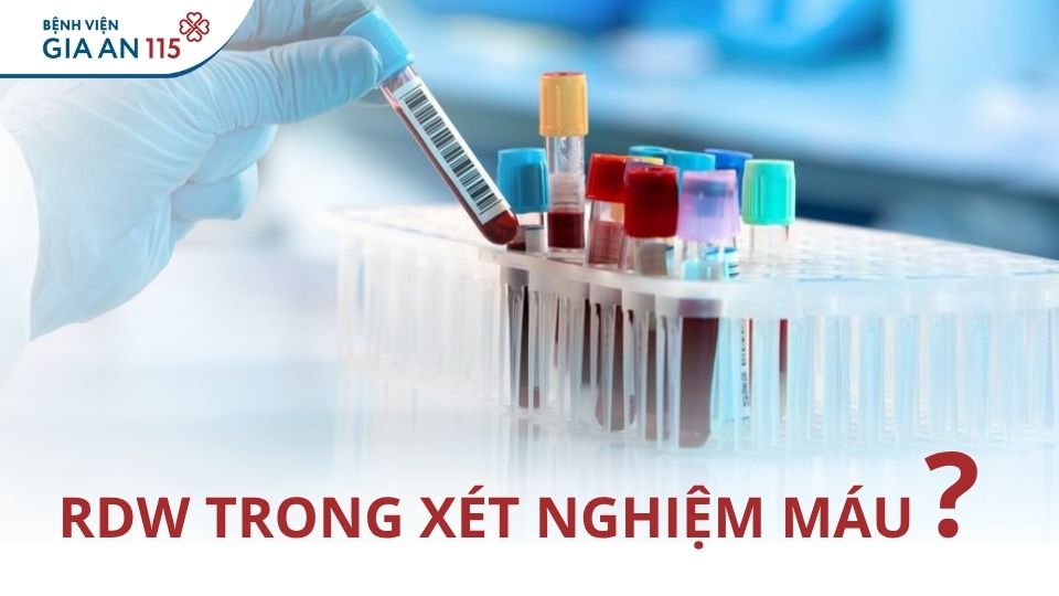 RDW trong xét nghiệm máu là gì? Chỉ số bao nhiêu là bình thường?