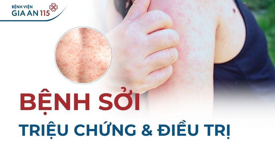 Phác đồ điều trị sởi mới nhất của Bộ Y tế cập nhật năm 2025