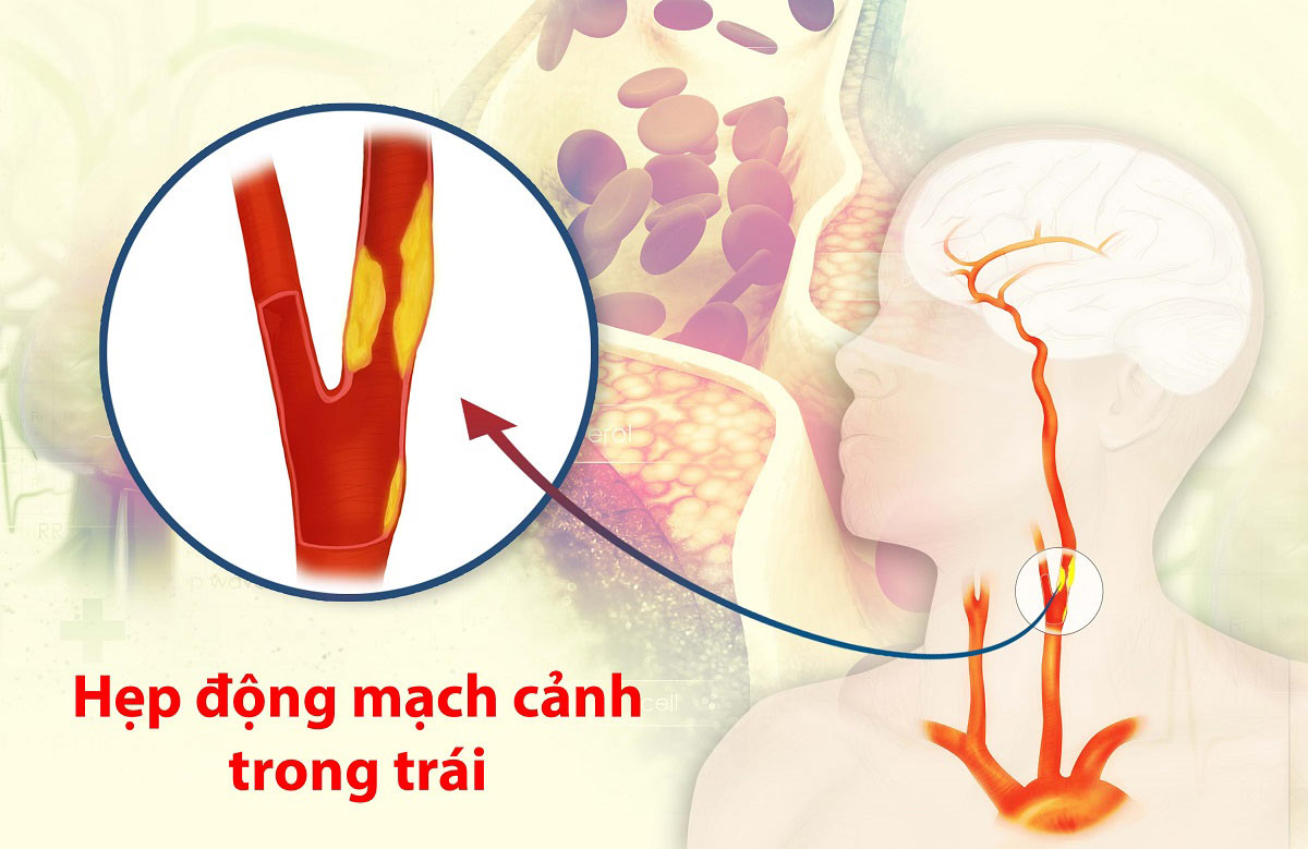 Đột quỵ thiếu máu não: Nhận biết nguyên nhân và cách phòng ngừa