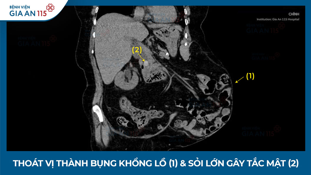 Một lần gây mê – hai can thiệp lớn: Thoát vị thành bụng khổng lồ và sỏi lớn gây tắc mật