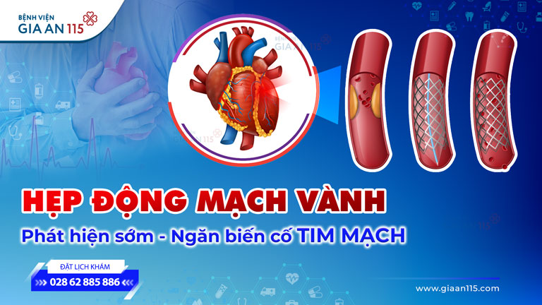 Hẹp động mạch vành: Phát hiện sớm ngăn chặn biến cố tim mạch cùng công nghệ CT tiên phong