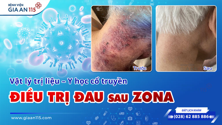 Điều trị đau sau zona bằng Vật lý trị liệu – Y học cổ truyền