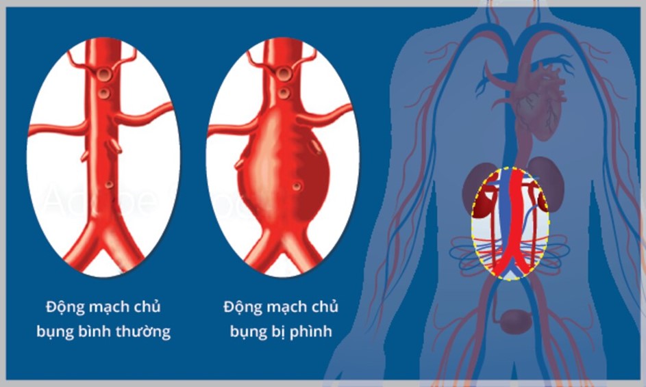 Dấu hiệu Phình động mạch chủ bụng