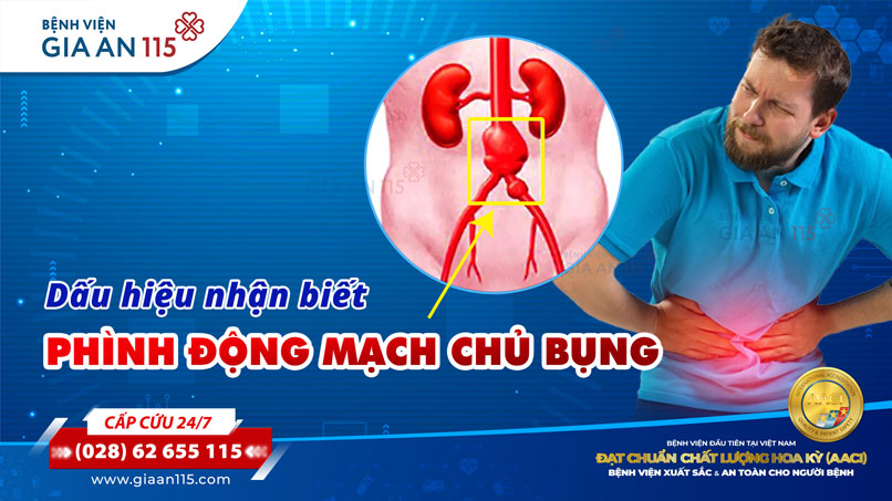 Dấu hiệu phình động mạch chủ bụng