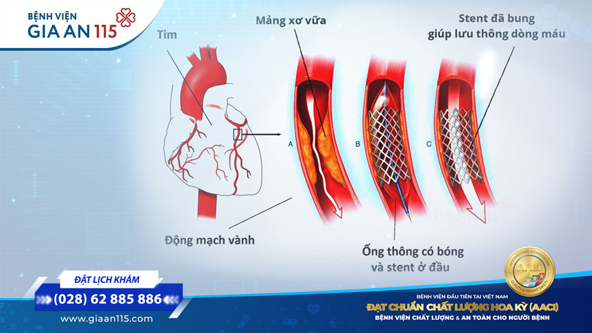 Gen đột biến khiến nhiều người Việt dễ biến chứng sau đặt stent