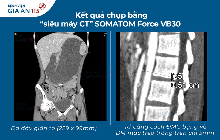 hội chứng động mạch mạc treo tràng trên 