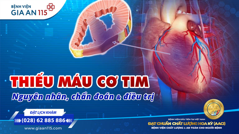 Thiếu máu cơ tim là gì