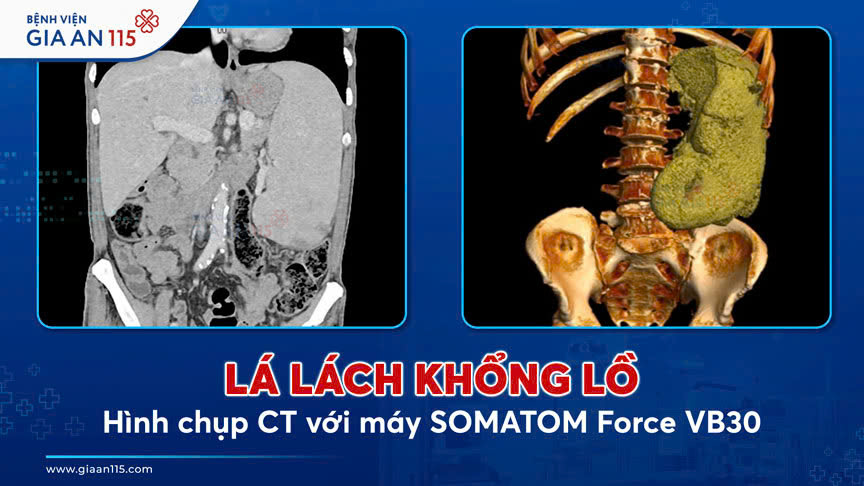 Cắt bỏ lá lách khổng lồ chiếm 1/4 ổ bụng của cụ ông gần 80 tuổi