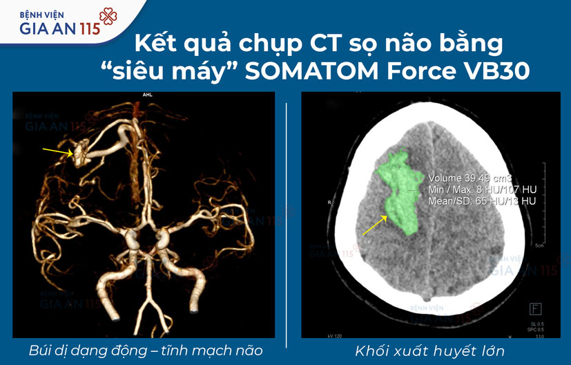 Cô gái 26 tuổi suýt tử vong sau cơn đau đầu lúc rạng sáng