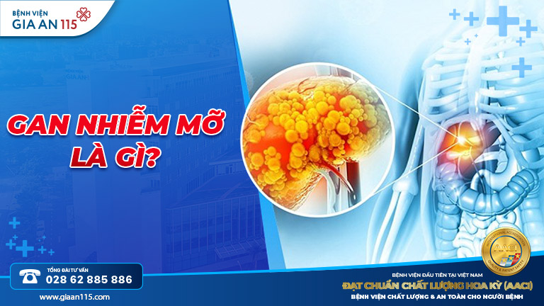 Mỡ máu cao có gây gan nhiễm mỡ không