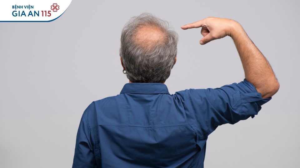 Rụng tóc bao nhiêu là bình thường