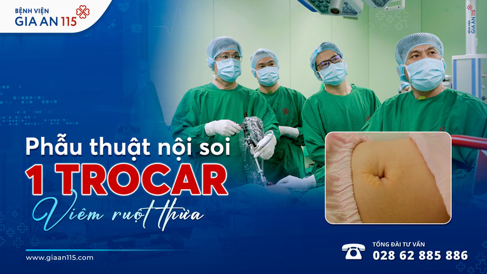 Mổ ruột thừa 1 trocar – bước tiến của phẫu thuật nội soi xâm lấn tối thiểu