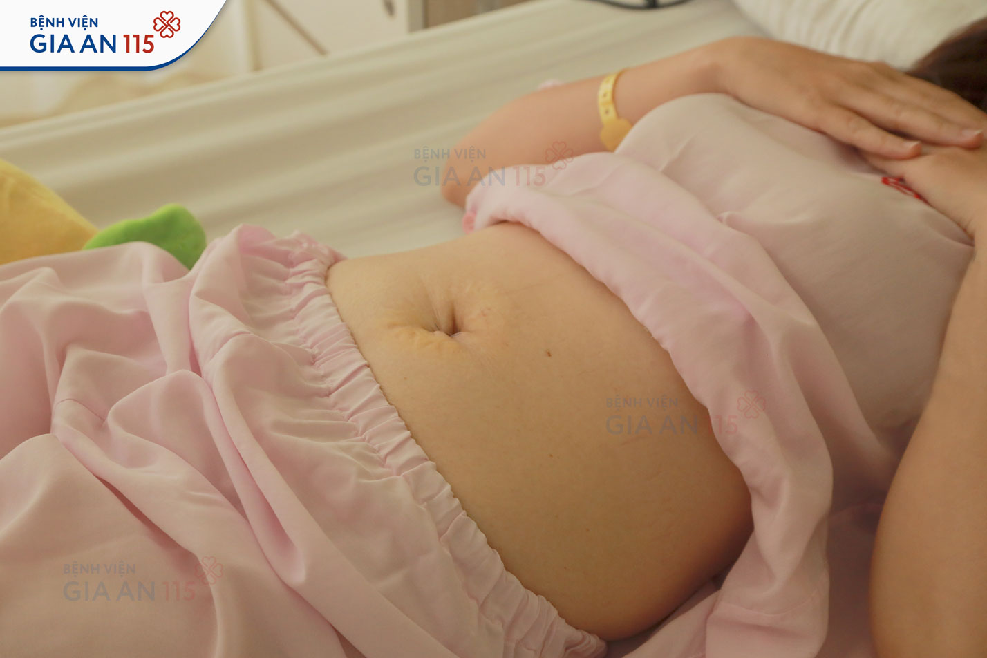 Mổ ruột thừa 1 trocar