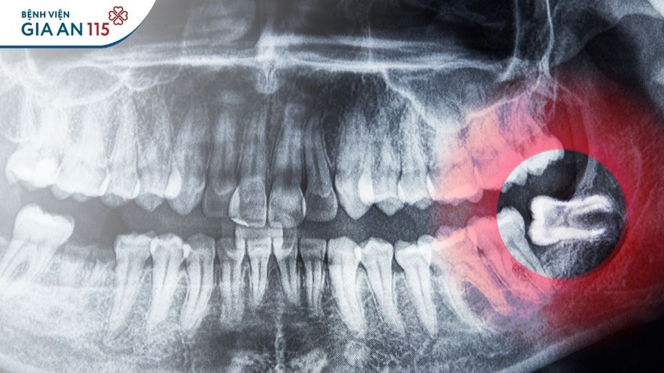 Chi phí nhổ răng khôn có bảo hiểm y tế 