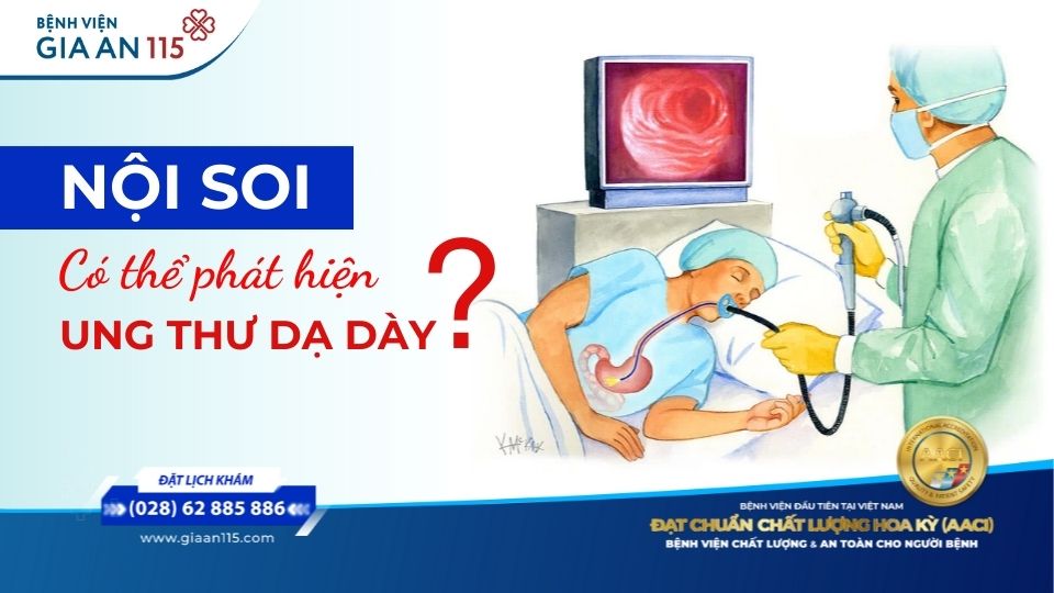Nội soi dạ dày có phát hiện ung thư không