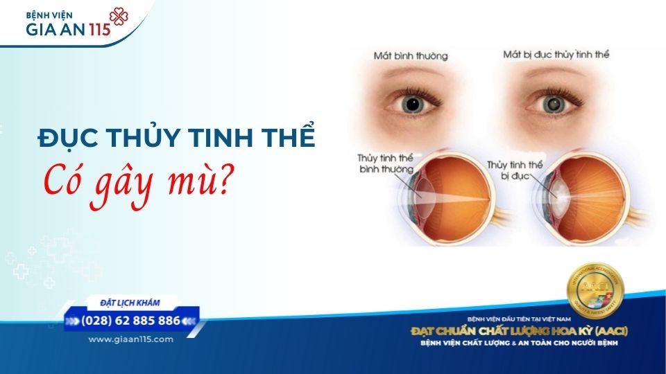 Đục thủy tinh thể có gây mù không