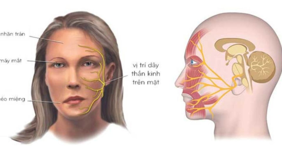 Cẩn trọng liệt dây thần kinh số 7 ngoại biên