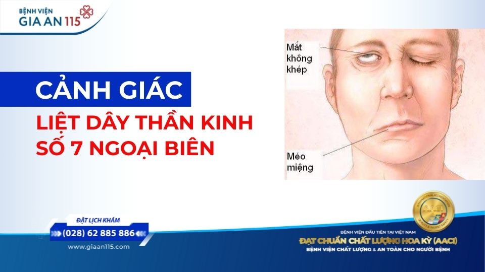 Cẩn trọng liệt dây thần kinh số 7 ngoại biên