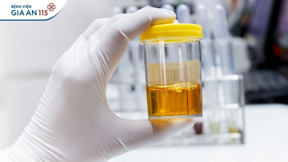 Viêm cầu thận mạn