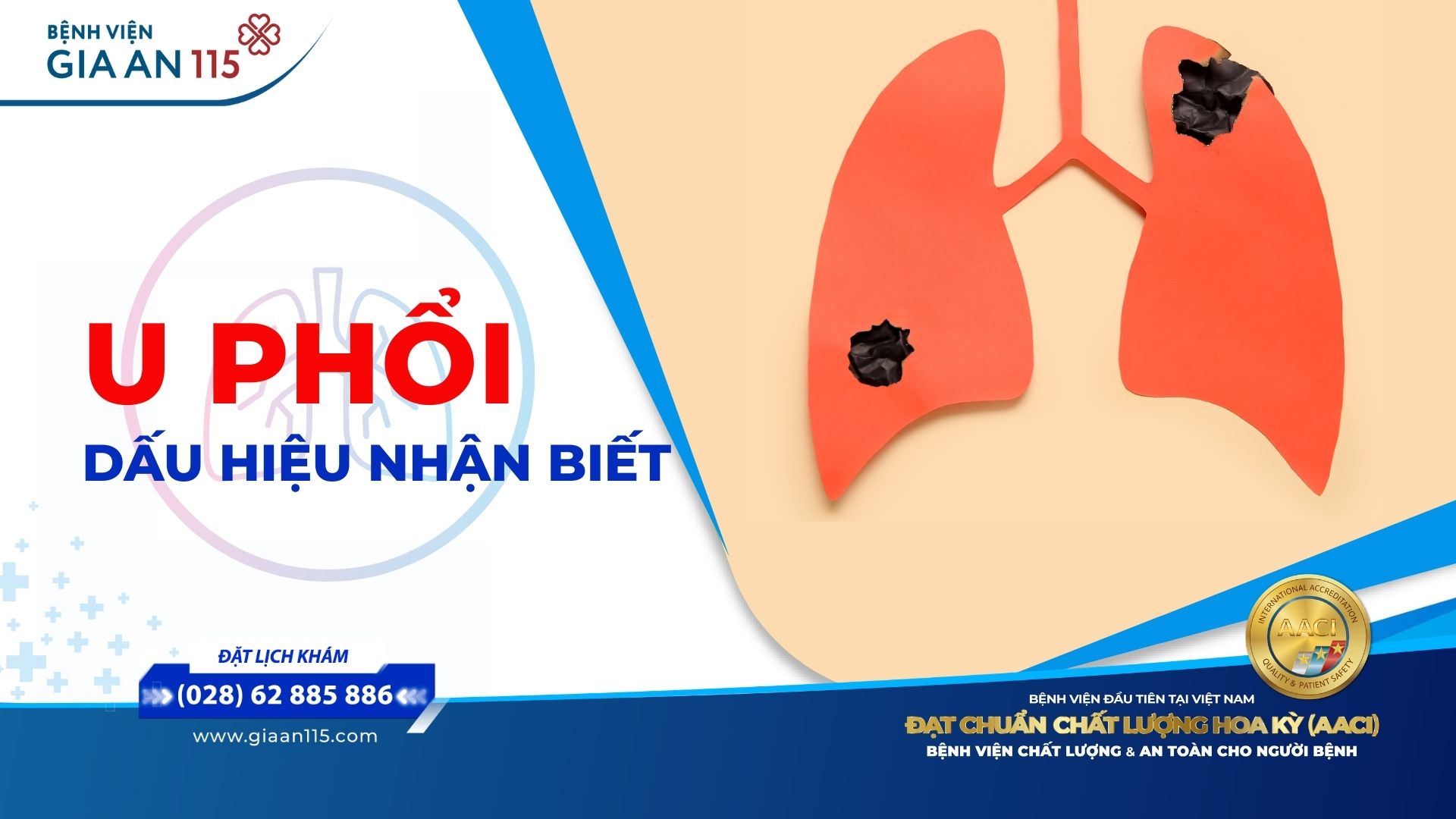 Dấu hiệu u phổi