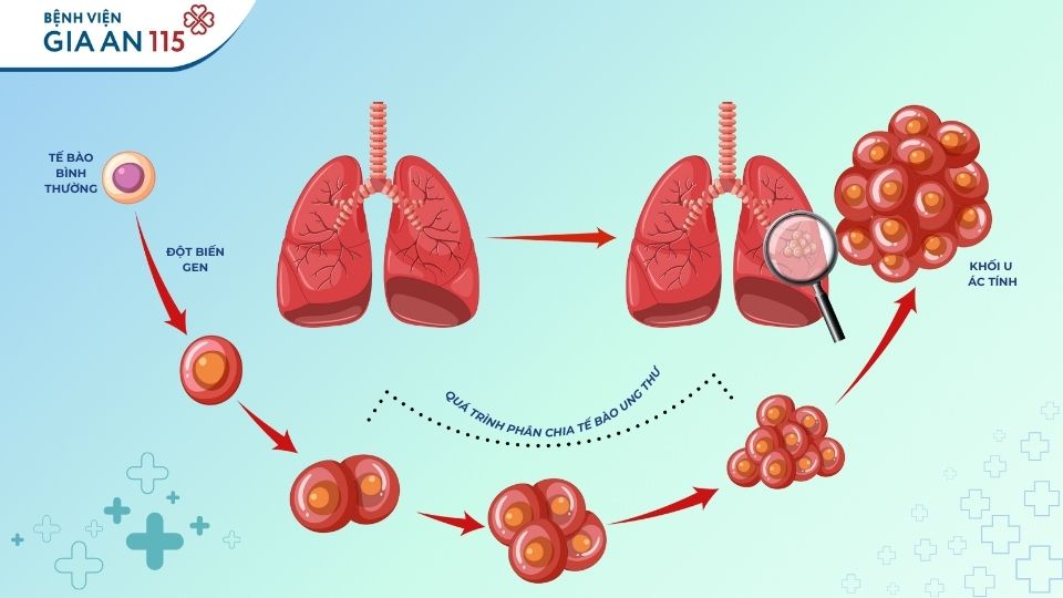 U phổi có phải ung thư không