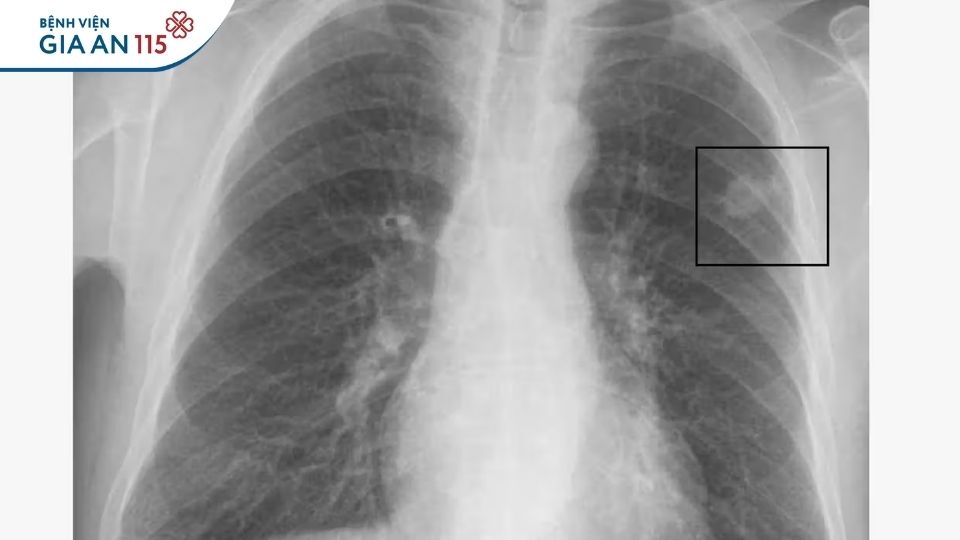 U phổi có phải ung thư không