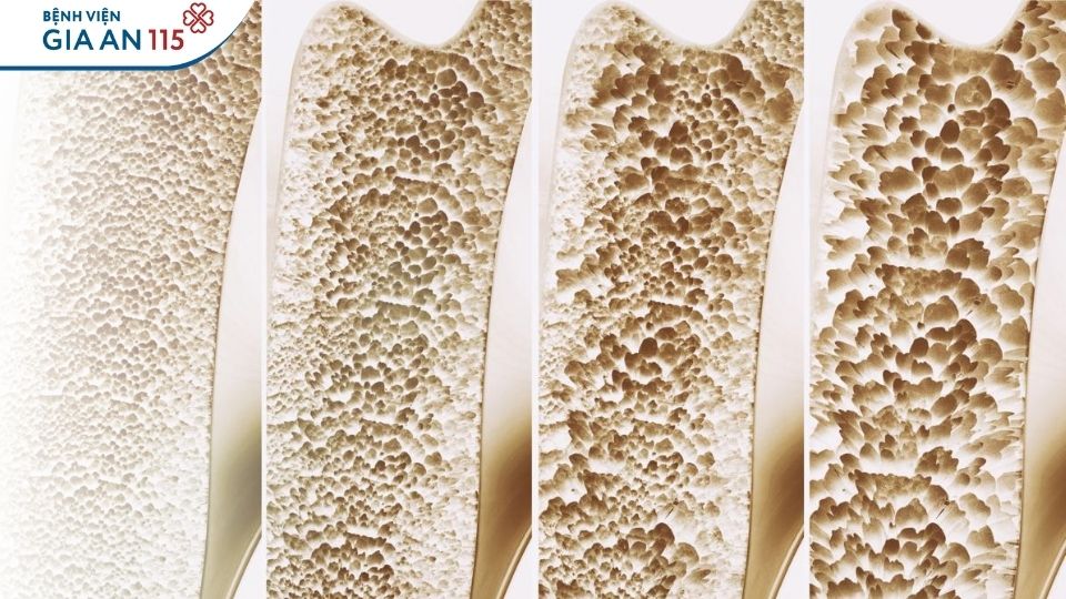 Xẹp đốt sống có hồi phục được không