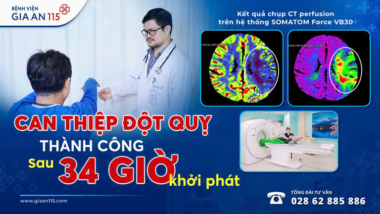 Can thiệp đột quỵ thành công ở giờ thứ 34 với sự hỗ trợ của hình ảnh học tiên tiến