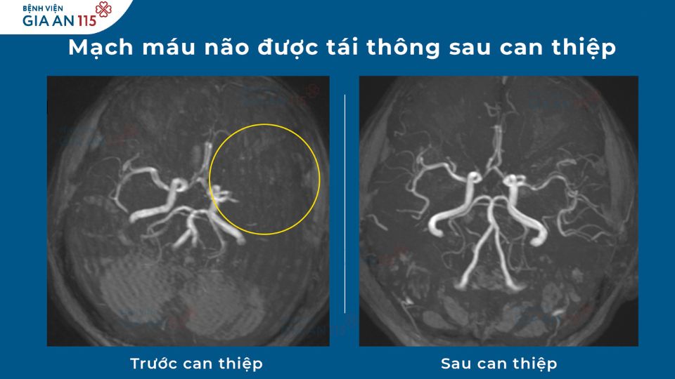 Can thiệp đột quỵ thành công ở giờ thứ 34