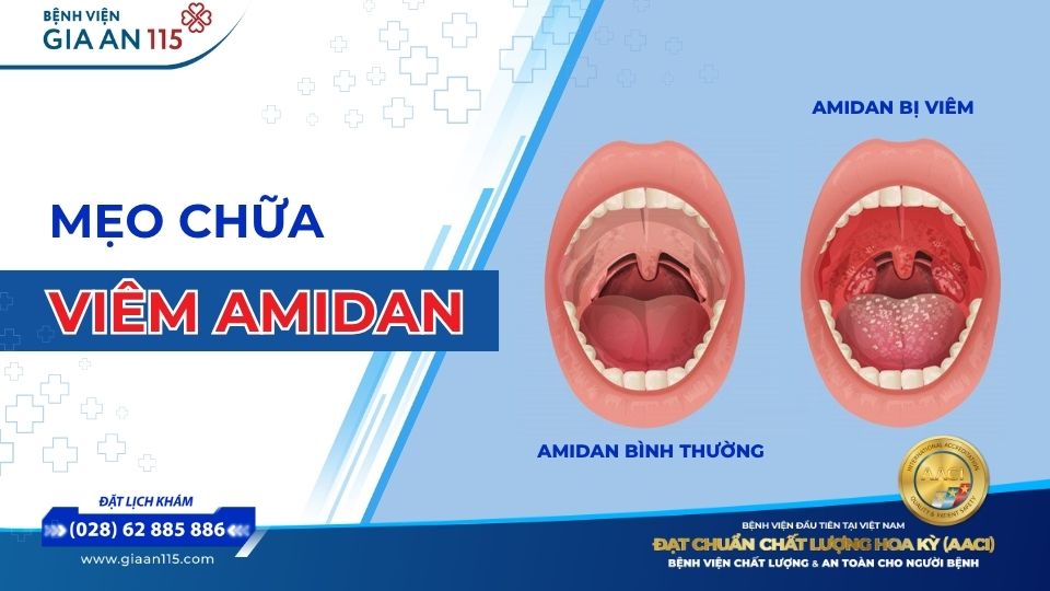 Mẹo chữa viêm amidan tại nhà