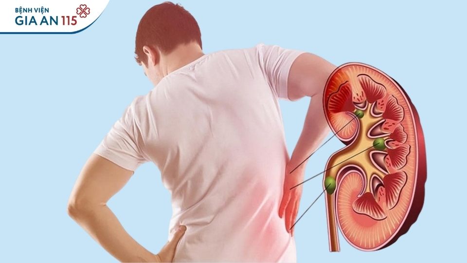 Dấu hiệu sỏi thận