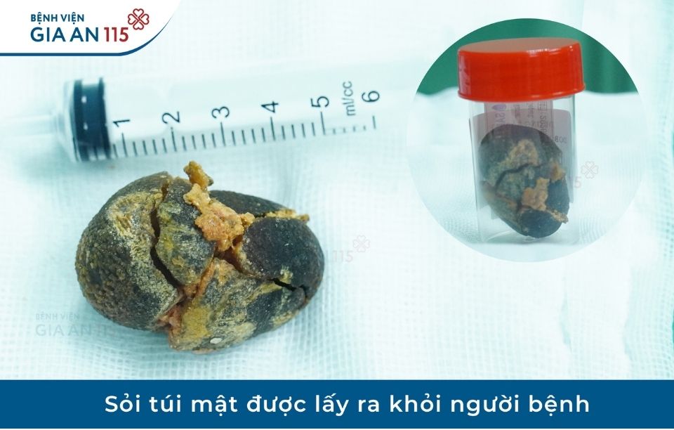 Người phụ nữ bất ngờ phát hiện sỏi mật 5cm, lớn gần bằng quả trứng gà