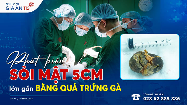 Người phụ nữ bất ngờ phát hiện sỏi mật 5cm, lớn gần bằng quả trứng gà